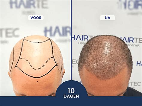 Haartransplantatie Kosten: Hoe Te Besparen?