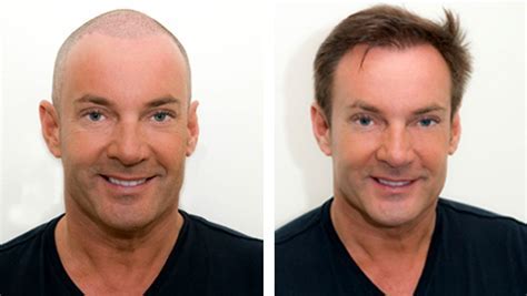 Haartransplantatie: Risico's En Complicaties