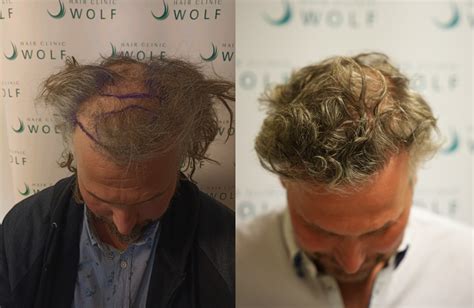 Haartransplantatie Voor En Na Resultaten: De Kwestie Van Geduld